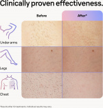 Braun Smart IPL Skin iexpert PL7253 IPL-apparat Braun Smart IPL Skin iexpert PL7253 IPL-apparat